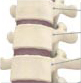 Forward Slipping Bones - Center for Spinal Correction